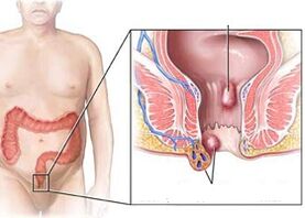 Anzeichen und Symptome von Hämorrhoiden